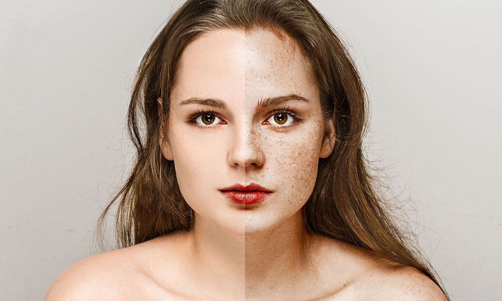 freckles 2